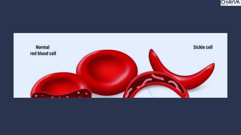 Sickle Cell Disease